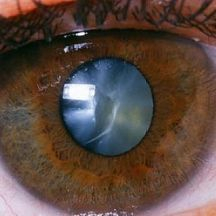 Slider image (2) Dr. Armando Capote - Eye Surgery Clinic in Cancun, Mexico